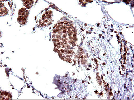 POLR3GL Antibody - IHC of paraffin-embedded Adenocarcinoma of Human breast tissue using anti-POLR3GL mouse monoclonal antibody. (Heat-induced epitope retrieval by 10mM citric buffer, pH6.0, 120°C for 3min).