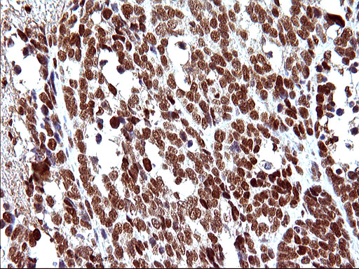 POLR3GL Antibody - IHC of paraffin-embedded Adenocarcinoma of Human colon tissue using anti-POLR3GL mouse monoclonal antibody. (Heat-induced epitope retrieval by 10mM citric buffer, pH6.0, 120°C for 3min).
