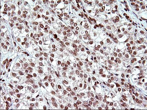 POLR3GL Antibody - IHC of paraffin-embedded Carcinoma of Human liver tissue using anti-POLR3GL mouse monoclonal antibody. (Heat-induced epitope retrieval by 10mM citric buffer, pH6.0, 120°C for 3min).