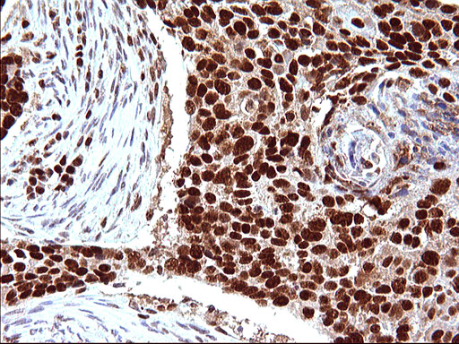 POLR3GL Antibody - IHC of paraffin-embedded Carcinoma of Human lung tissue using anti-POLR3GL mouse monoclonal antibody. (Heat-induced epitope retrieval by 10mM citric buffer, pH6.0, 120°C for 3min).