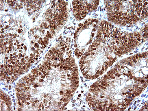 POLR3GL Antibody - IHC of paraffin-embedded Carcinoma of Human pancreas tissue using anti-POLR3GL mouse monoclonal antibody. (Heat-induced epitope retrieval by 10mM citric buffer, pH6.0, 120°C for 3min).