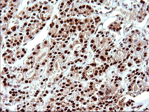 POLR3GL Antibody - IHC of paraffin-embedded Carcinoma of Human thyroid tissue using anti-POLR3GL mouse monoclonal antibody. (Heat-induced epitope retrieval by 10mM citric buffer, pH6.0, 120°C for 3min).