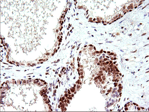 POLR3GL Antibody - IHC of paraffin-embedded Carcinoma of Human prostate tissue using anti-POLR3GL mouse monoclonal antibody. (Heat-induced epitope retrieval by 10mM citric buffer, pH6.0, 120°C for 3min).