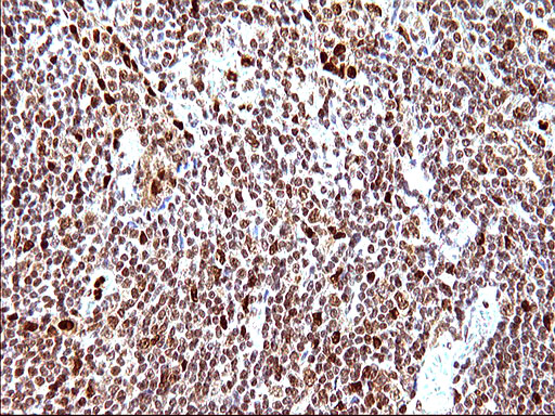 POLR3GL Antibody - IHC of paraffin-embedded Human lymphoma tissue using anti-POLR3GL mouse monoclonal antibody. (Heat-induced epitope retrieval by 10mM citric buffer, pH6.0, 120°C for 3min).