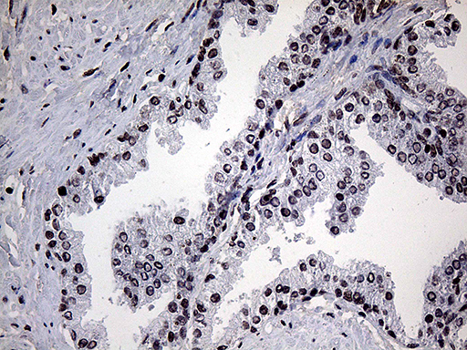 POLR3H Antibody - Immunohistochemical staining of paraffin-embedded Carcinoma of Human prostate tissue using anti-POLR3H mouse monoclonal antibody. (Heat-induced epitope retrieval by 1mM EDTA in 10mM Tris buffer. (pH8.5) at 120°C for 3 min. (1:150)