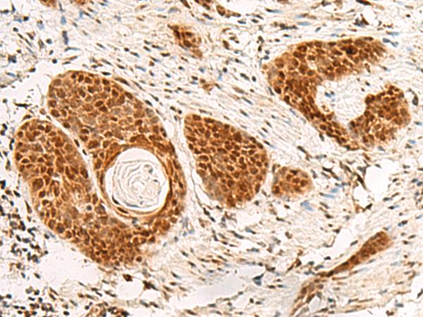 POM121 Antibody - Immunohistochemistry of paraffin-embedded Human esophagus cancer tissue  using POM121 Polyclonal Antibody at dilution of 1:75(×200)