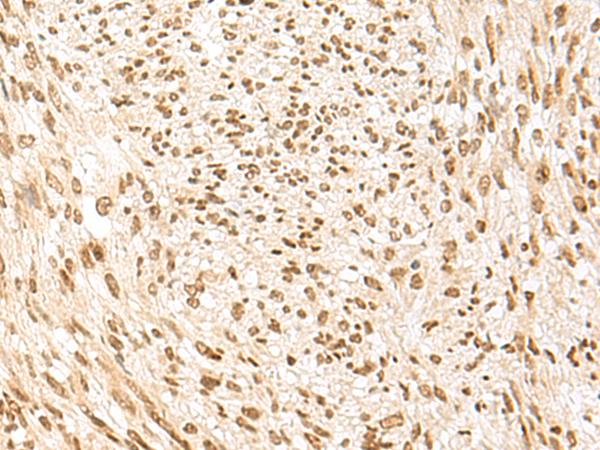POM121 Antibody - Immunohistochemistry of paraffin-embedded Human liver cancer tissue  using POM121 Polyclonal Antibody at dilution of 1:75(×200)