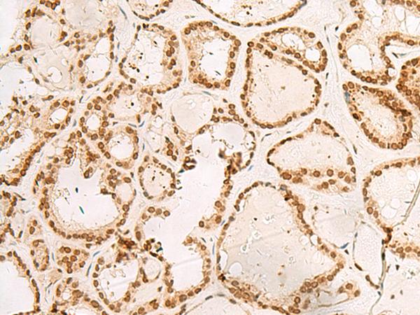POM121 Antibody - Immunohistochemistry of paraffin-embedded Human thyroid cancer tissue  using POM121 Polyclonal Antibody at dilution of 1:40(×200)