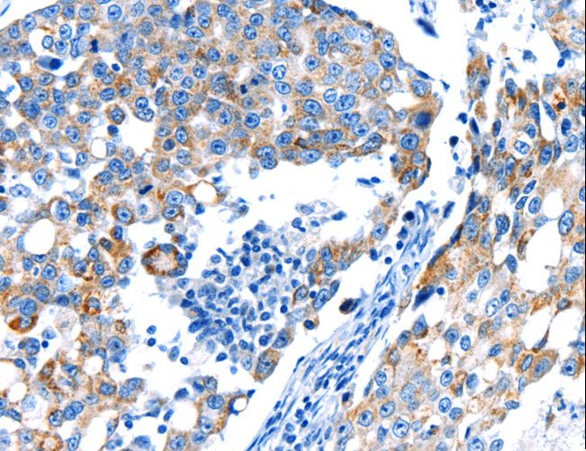 POMC / Proopiomelanocortin Antibody - Immunohistochemistry of paraffin-embedded Human breast cancer using POMC Polyclonal Antibody at dilution of 1:30.