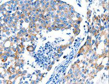 POMC / Proopiomelanocortin Antibody - Immunohistochemistry of paraffin-embedded Human breast cancer using POMC Polyclonal Antibody at dilution of 1:30.