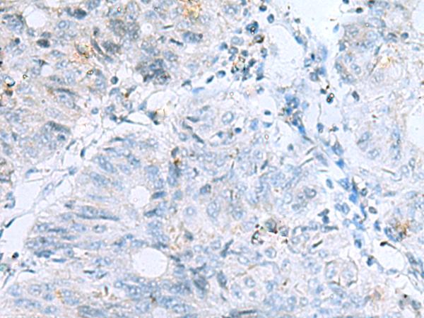 POMC / Proopiomelanocortin Antibody - Immunohistochemistry of paraffin-embedded Human colorectal cancer tissue  using POMC Polyclonal Antibody at dilution of 1:35(×200)