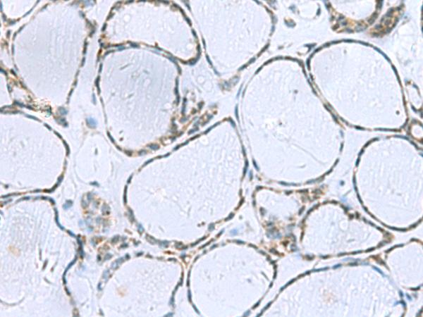 POMC / Proopiomelanocortin Antibody - Immunohistochemistry of paraffin-embedded Human thyroid cancer tissue  using POMC Polyclonal Antibody at dilution of 1:35(×200)
