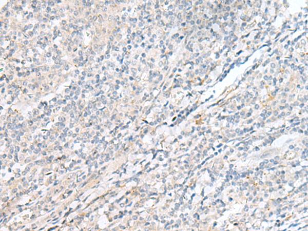 POMGNT1 Antibody - Immunohistochemistry of paraffin-embedded Human tonsil tissue  using POMGNT1 Polyclonal Antibody at dilution of 1:55(×200)