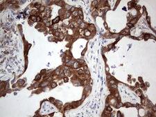 POMK / SGK196 Antibody - Immunohistochemical staining of paraffin-embedded Carcinoma of Human lung tissue using anti-SGK196 Mouse monoclonal antibody.  heat-induced epitope retrieval by 1 mM EDTA in 10mM Tris, pH8.5, 120C for 3min)