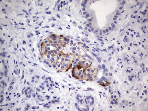 POMK / SGK196 Antibody - Immunohistochemical staining of paraffin-embedded Carcinoma of Human pancreas tissue using anti-SGK196 Mouse monoclonal antibody.  heat-induced epitope retrieval by 1 mM EDTA in 10mM Tris, pH8.5, 120C for 3min)
