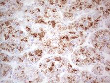 POMK / SGK196 Antibody - Immunohistochemical staining of paraffin-embedded Carcinoma of Human liver tissue using anti-SGK196 mouse monoclonal antibody. (Heat-induced epitope retrieval by 1 mM EDTA in 10mM Tris, pH8.5, 120C for 3min,