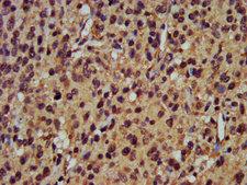 POMP / HSPC014 Antibody - IHC image of POMP Antibody diluted at 1:400 and staining in paraffin-embedded human glioma performed on a Leica BondTM system. After dewaxing and hydration, antigen retrieval was mediated by high pressure in a citrate buffer (pH 6.0). Section was blocked with 10% normal goat serum 30min at RT. Then primary antibody (1% BSA) was incubated at 4°C overnight. The primary is detected by a biotinylated secondary antibody and visualized using an HRP conjugated SP system.