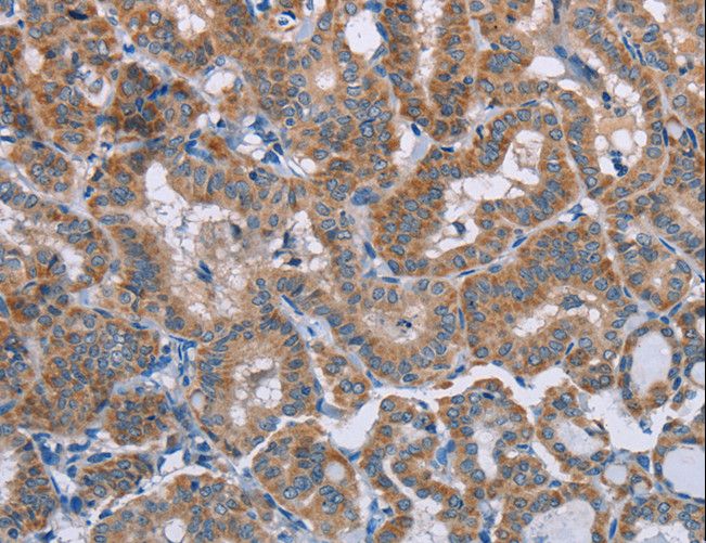 POMT1 Antibody - Immunohistochemistry of paraffin-embedded Human thyroid cancer using POMT1 Polyclonal Antibody at dilution of 1:50.