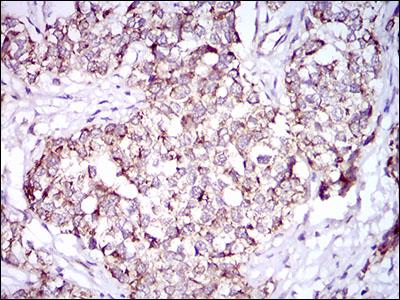 PON1 / ESA Antibody - Immunohistochemistry: PON1 Antibody (4G8D3) - Immunohistochemical analysis of paraffin-embedded human bladder cancer tissues with DAB staining.  This image was taken for the unconjugated form of this product. Other forms have not been tested.