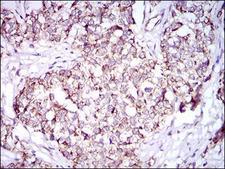 PON1 / ESA Antibody - Immunohistochemistry: PON1 Antibody (4G8D3) - Immunohistochemical analysis of paraffin-embedded human bladder cancer tissues with DAB staining.  This image was taken for the unconjugated form of this product. Other forms have not been tested.