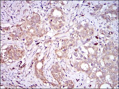 PON1 / ESA Antibody - Immunohistochemistry: PON1 Antibody (4G8D3) - Immunohistochemical analysis of paraffin-embedded human cervical cancer tissues with DAB staining.  This image was taken for the unconjugated form of this product. Other forms have not been tested.