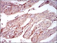 PON1 / ESA Antibody - IHC of paraffin-embedded rectum cancer tissues using PON1 mouse monoclonal antibody with DAB staining.