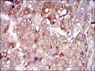 PON1 / ESA Antibody - IHC of paraffin-embedded liver cancer tissues using PON1 mouse monoclonal antibody with DAB staining.