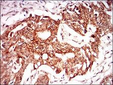 PON1 / ESA Antibody - IHC of paraffin-embedded rectum cancer tissues using PON1 mouse monoclonal antibody with DAB staining.