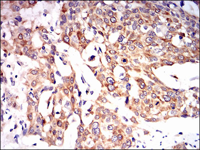 PON1 / ESA Antibody - IHC of paraffin-embedded esophageal cancer tissues using PON1 mouse monoclonal antibody with DAB staining.