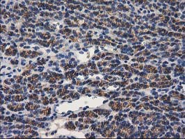 PON1 / ESA Antibody - IHC of paraffin-embedded Carcinoma of Human thyroid tissue using anti-PON1 mouse monoclonal antibody. (Heat-induced epitope retrieval by 10mM citric buffer, pH6.0, 100C for 10min).