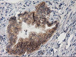 PON1 / ESA Antibody - IHC of paraffin-embedded Adenocarcinoma of Human colon tissue using anti-PON1 mouse monoclonal antibody. (Heat-induced epitope retrieval by 10mM citric buffer, pH6.0, 100C for 10min).