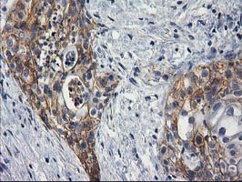 PON1 / ESA Antibody - IHC of paraffin-embedded Carcinoma of Human pancreas tissue using anti-PON1 mouse monoclonal antibody. (Heat-induced epitope retrieval by 10mM citric buffer, pH6.0, 100C for 10min).
