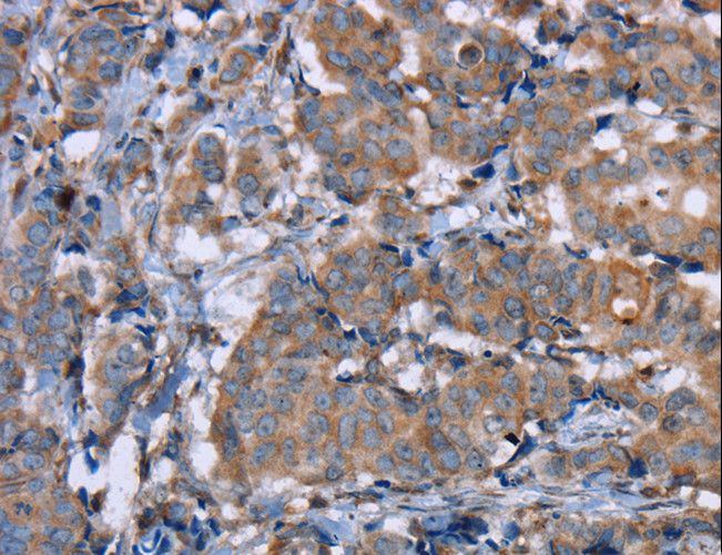 PON1 / ESA Antibody - Immunohistochemistry of paraffin-embedded Human breast cancer using PON1 Polyclonal Antibody at dilution of 1:40.