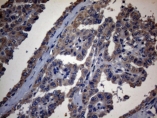 PON3 Antibody - Immunohistochemical staining of paraffin-embedded Carcinoma of Human thyroid tissue using anti-PON3 mouse monoclonal antibody. (Heat-induced epitope retrieval by 1mM EDTA in 10mM Tris buffer. (pH8.5) at 120°C for 3 min. (1:2000)