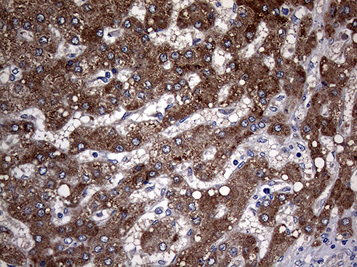 PON3 Antibody - Immunohistochemical staining of paraffin-embedded Carcinoma of Human liver tissue using anti-PON3 mouse monoclonal antibody. (Heat-induced epitope retrieval by 1mM EDTA in 10mM Tris buffer. (pH8.5) at 120°C for 3 min. (1:2000)