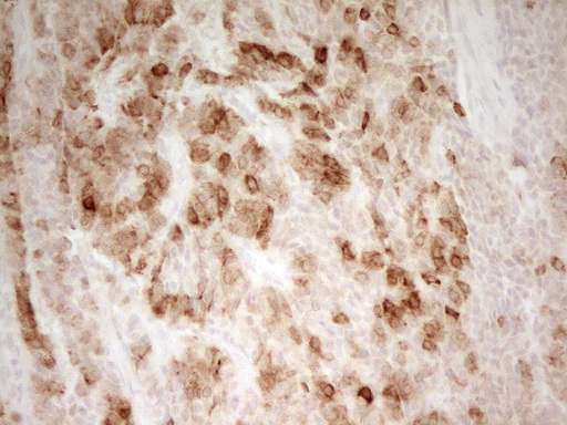 PON3 Antibody - Immunohistochemical staining of paraffin-embedded Carcinoma of Human lung tissue using anti-PON3 mouse monoclonal antibody. (Heat-induced epitope retrieval by 1 mM EDTA in 10mM Tris, pH8.5, 120C for 3min,