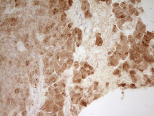 PON3 Antibody - Immunohistochemical staining of paraffin-embedded Carcinoma of Human lung tissue using anti-PON3 mouse monoclonal antibody. (Heat-induced epitope retrieval by 1 mM EDTA in 10mM Tris, pH8.5, 120C for 3min,