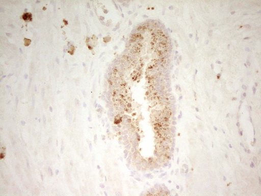 PON3 Antibody - Immunohistochemical staining of paraffin-embedded Adenocarcinoma of Human endometrium tissue using anti-PON3 mouse monoclonal antibody. (Heat-induced epitope retrieval by 1 mM EDTA in 10mM Tris, pH8.5, 120C for 3min,