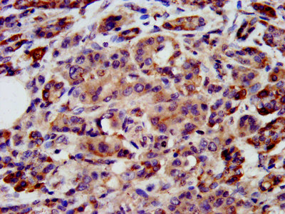 PON3 Antibody - Immunohistochemistry image at a dilution of 1:200 and staining in paraffin-embedded human pancreatic cancer performed on a Leica BondTM system. After dewaxing and hydration, antigen retrieval was mediated by high pressure in a citrate buffer (pH 6.0) . Section was blocked with 10% normal goat serum 30min at RT. Then primary antibody (1% BSA) was incubated at 4 °C overnight. The primary is detected by a biotinylated secondary antibody and visualized using an HRP conjugated SP system.