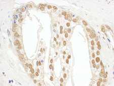 POP1 Antibody - Detection of Human POP1 by Immunohistochemistry. Sample: FFPE section of human prostate carcinoma. Antibody: Affinity purified rabbit anti-POP1 used at a dilution of 1:250.