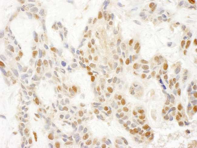 POP1 Antibody - Detection of Human POP1 by Immunohistochemistry. Sample: FFPE section of human skin tumor. Antibody: Affinity purified rabbit anti-POP1 used at a dilution of 1:250.