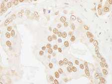 POP1 Antibody - Detection of Human POP1 by Immunohistochemistry. Sample: FFPE section of human prostate carcinoma. Antibody: Affinity purified rabbit anti-POP1 used at a dilution of 1:5000 (0.2 ug/ml). Detection: DAB.