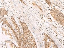 POP4 Antibody - Immunohistochemistry of paraffin-embedded Human esophagus cancer tissue  using POP4 Polyclonal Antibody at dilution of 1:65(×200)