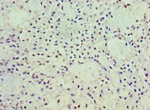 POSTN / Periostin Antibody - Immunohistochemistry of paraffin-embedded human breast cancer using antibody at 1:100 dilution.