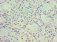 POSTN / Periostin Antibody - Immunohistochemistry of paraffin-embedded human breast cancer using antibody at 1:100 dilution.