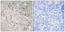 POTEA / POTE8 Antibody - Peptide - + Immunohistochemistry analysis of paraffin-embedded human prostate carcinoma tissue using POTE8 antibody.