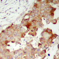 POTEB3 / POTE-15 Antibody - Immunohistochemical analysis of POTEB staining in human prostate cancer formalin fixed paraffin embedded tissue section. The section was pre-treated using heat mediated antigen retrieval with sodium citrate buffer (pH 6.0). The section was then incubated with the antibody at room temperature and detected using an HRP polymer system. DAB was used as the chromogen. The section was then counterstained with hematoxylin and mounted with DPX.
