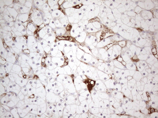POTEG Antibody - Immunohistochemical staining of paraffin-embedded Carcinoma of Human kidney tissue using anti-POTEG mouse monoclonal antibody. (Heat-induced epitope retrieval by 1mM EDTA in 10mM Tris buffer. (pH8.5) at 120°C for 3 min. (1:150)