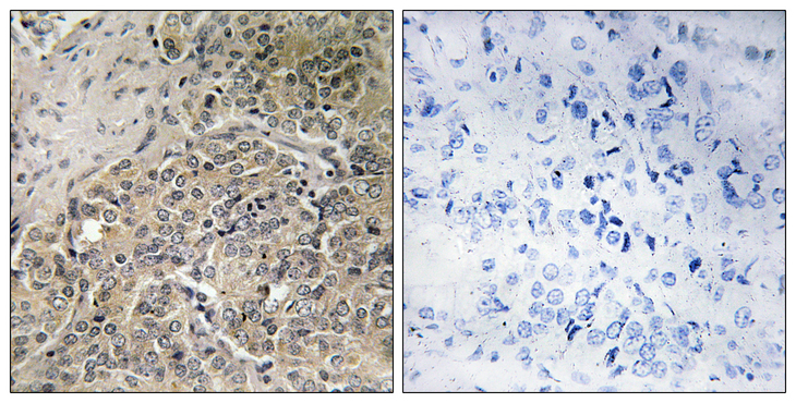 POTEH Antibody - Immunohistochemistry analysis of paraffin-embedded human prostate carcinoma, using A26C2/3 Antibody. The picture on the right is blocked with the synthesized peptide.