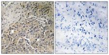 POTEH Antibody - Immunohistochemistry analysis of paraffin-embedded human prostate carcinoma, using A26C2/3 Antibody. The picture on the right is blocked with the synthesized peptide.